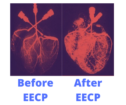 String Ecp Test China Hospital equipment ECP machine, EECP machine, external ...