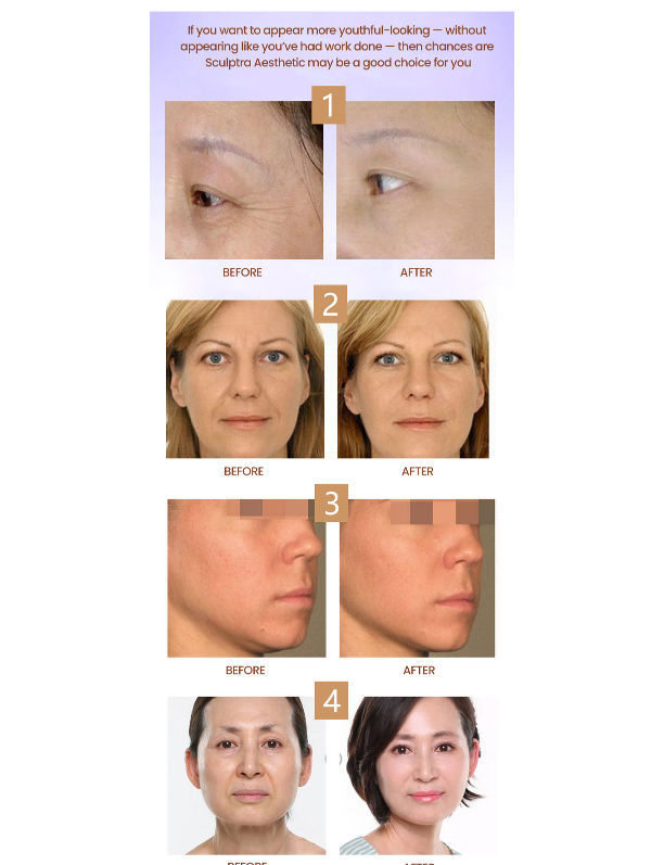 China Sculptra butt injection sculptra poly l lactic acid sculptra butt ...
