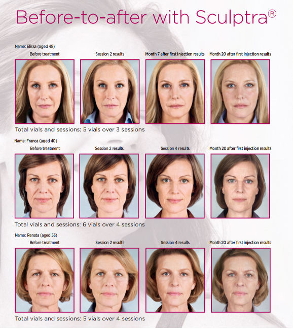 Sculptra Plla Filler Power Sculptra Butt Injection Facial Rejuvenation ...