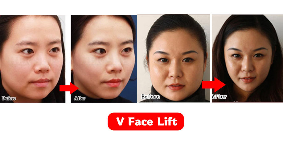 High Quality V Line Face Shaper Relaxation Lift Up Belt Elastic Face  Slimming Bandage - China Wholesale Face Slimming Bandage $1.8 from Hebei  Shangju Technology Co., Ltd.