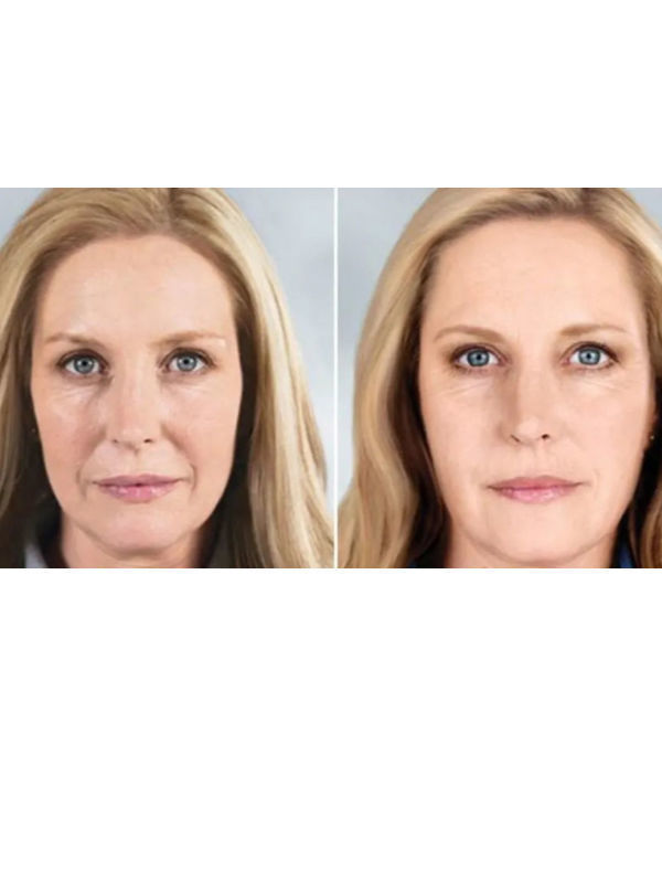 High Inj for Injection for Skin Rejuvenation Whitening Anti-Aging Go to ...