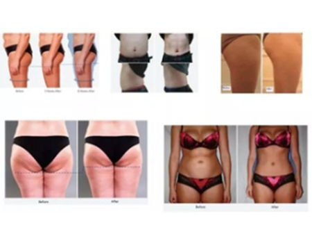 Emsculpt аппарат отзывы до и после 2021 Hot Muscle Sculpt Fat Reduce Body Sculpting slim Machine Manufacturer ems f
