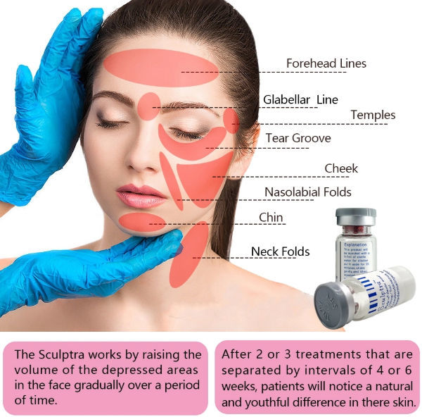Poly l lactic acid sculptra collagen for jowls sanofi aventis lips under eyes face buttocks near