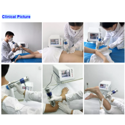 Shockwave Therapy Machine, For Hospital