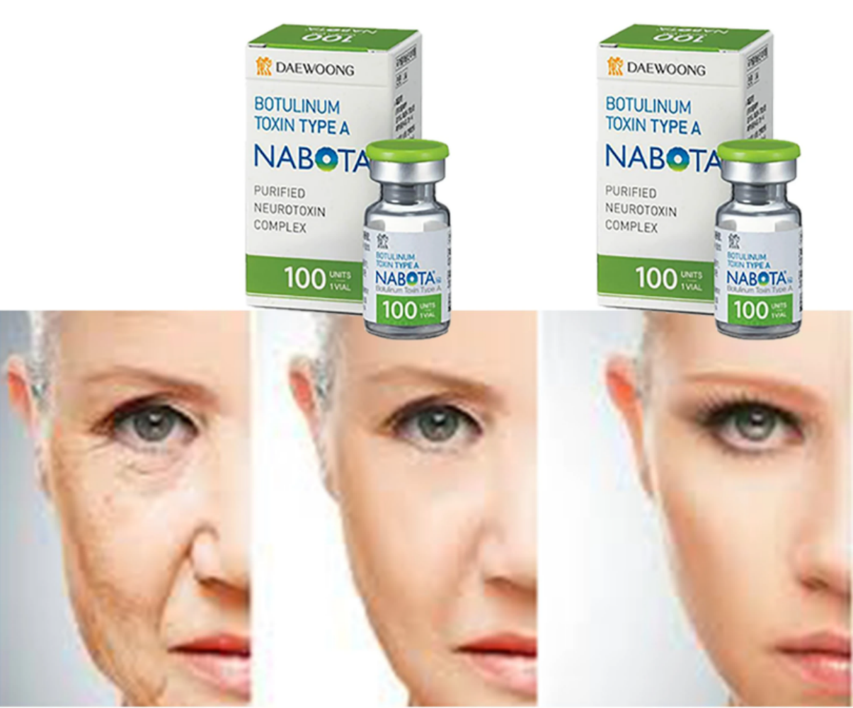 Buy Wholesale China Nabota 200 Units Nabota 100u Anti Aging Injection ...