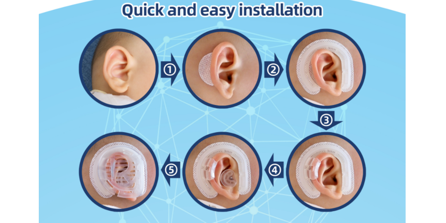 Buy Wholesale China Non-invasive Ear Correction Kit Auricle Deformity ...