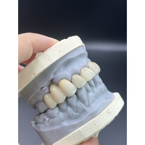 Heißer Verkauf von Zahnveneers, Dentallabor, kundenspezifische Zirkonkronen, Brücken/Implantate, Prothesen für ästhetische Anforderungen.