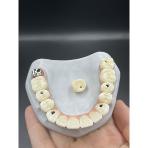 Heißer Verkauf von Zahnveneers, Dentallabor, kundenspezifische Zirkonkronen, Brücken/Implantate, Prothesen für ästhetische Anforderungen.