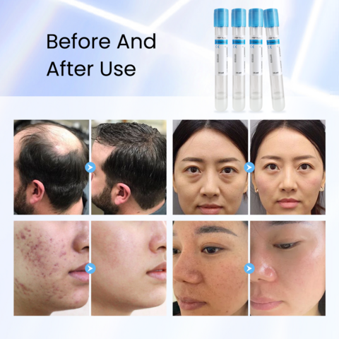 Tabung prp biotin gel acd steril medis 10ml 15ml dengan antikoagulan