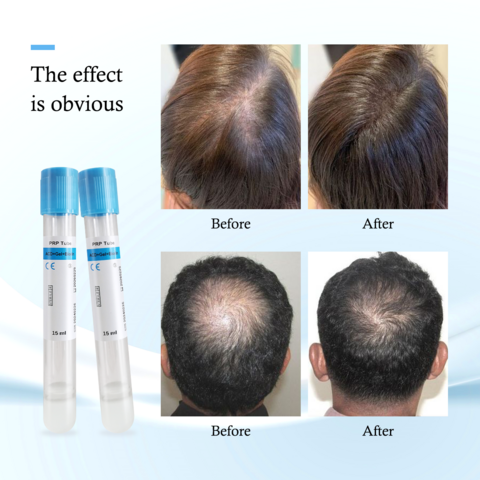 Tabung prp biotin gel acd steril medis 10ml 15ml dengan antikoagulan
