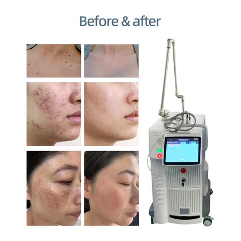 BOWKET Tragbarer fraktionierter CO2-Laser Metallröhre Vaginal- & Gesichts-Beauty-Spa-Ausrüstung