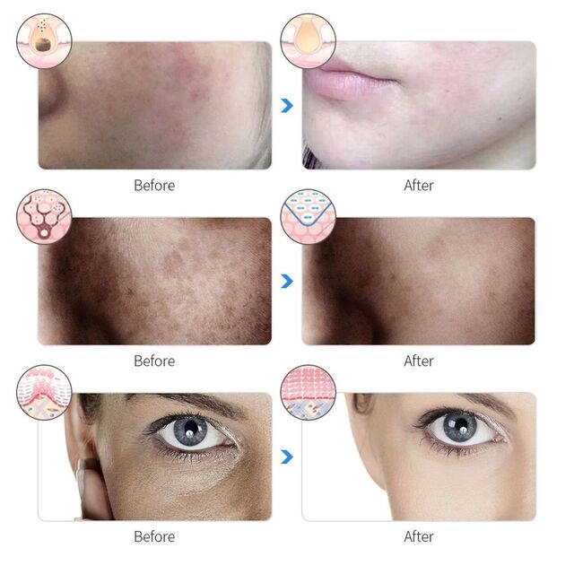 Fournisseur de masque de luminothérapie LED professionnel multi-longueurs d'onde pour la dermatologie et l'esthétique